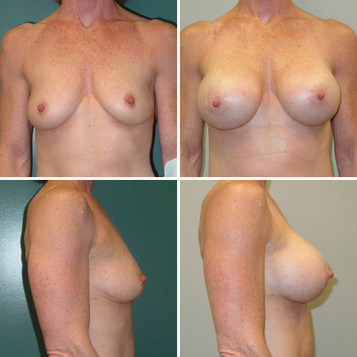 Breast Augmentation Before & After Photos