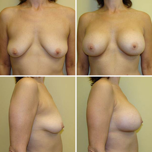 Breast Augmentation Before & After Photos