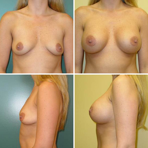 Breast Augmentation Before & After Photos