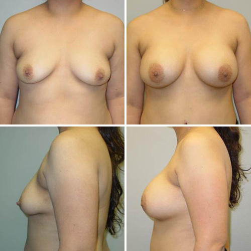 Breast Augmentation Before & After Photos