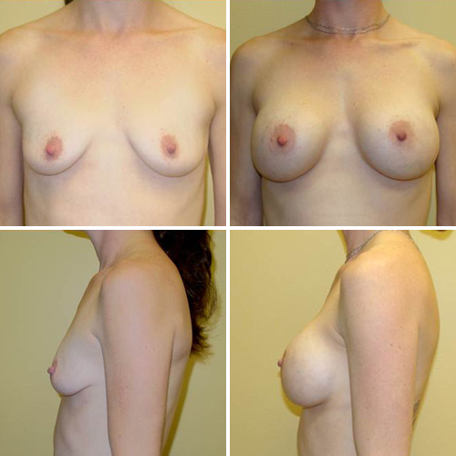 Breast Augmentation Before & After Photos