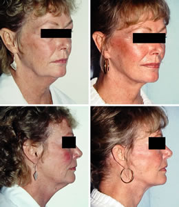 Facelift Before & After Photos