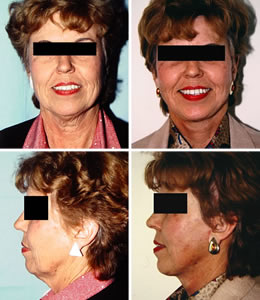 Facelift Before & After Photos