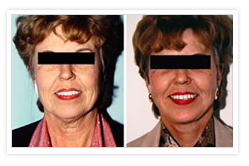 Facelift Before & After Photos