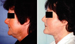 Facelift Before & After Photos