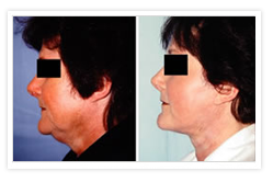 Facelift Before & After Photos