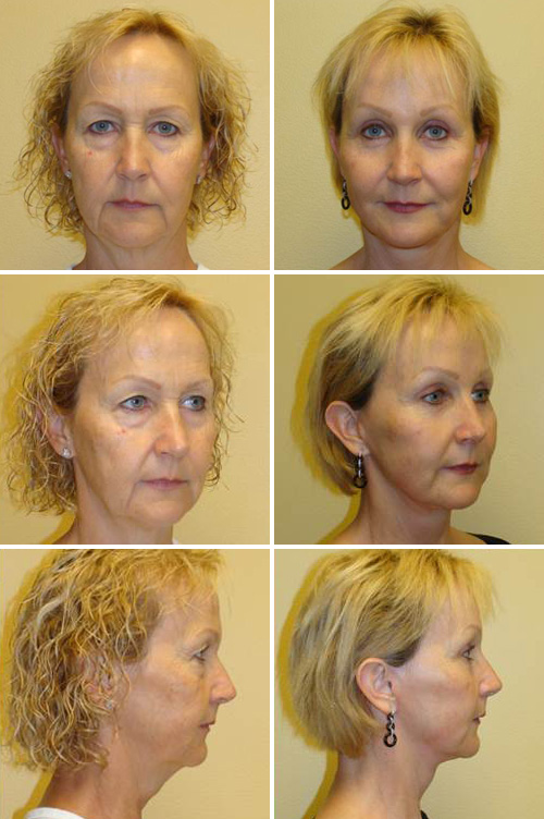 Facelift Before & After Photos