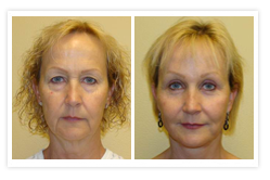 Facelift Before & After Photos