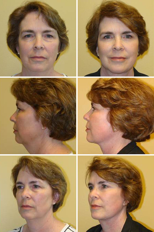 Facelift Before & After Photos