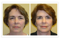 Facelift Before & After Photos