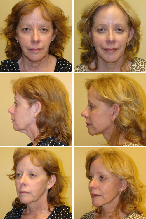 Facelift Before & After Photos