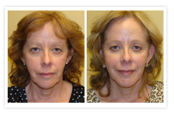 Facelift Before & After Photos