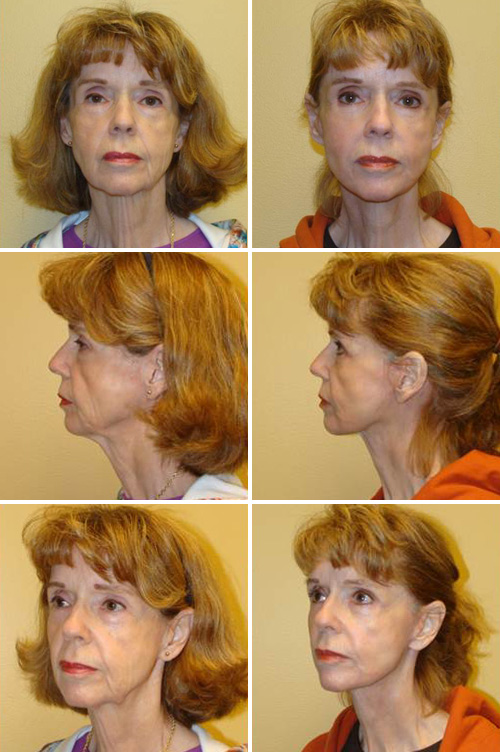 Facelift Before & After Photos