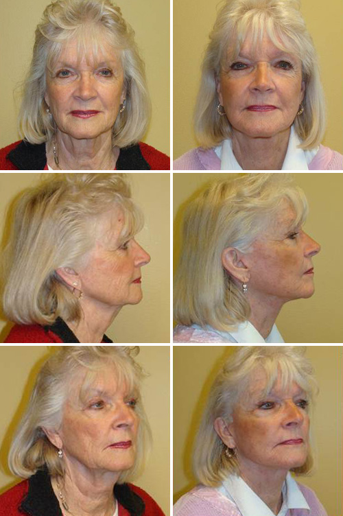 Facelift Before & After Photos