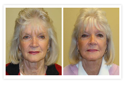 Facelift Before & After Photos