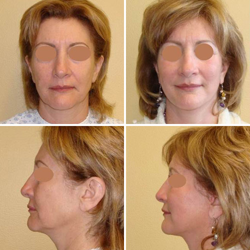 Facelift Before & After Photos