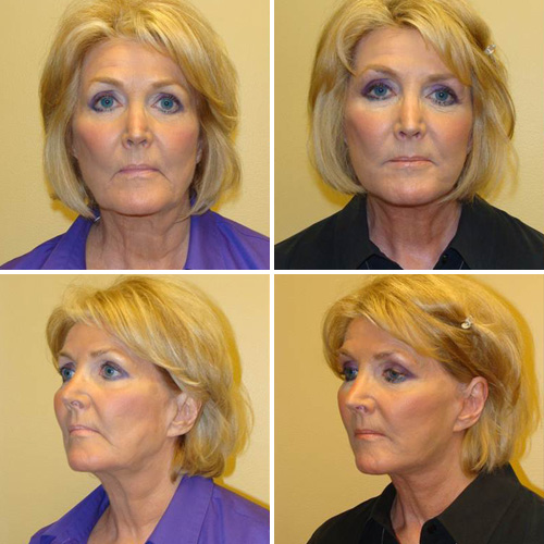 Facelift Before & After Photos