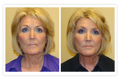 Facelift Before & After Photos