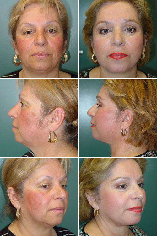 Facelift Before & After Photos