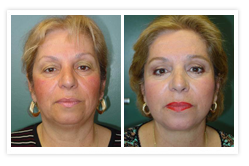 Facelift Before & After Photos