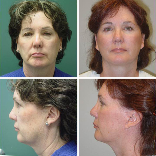 Facelift Before & After Photos