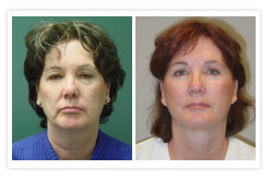 Facelift Before & After Photos