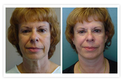 Facelift Before & After Photos