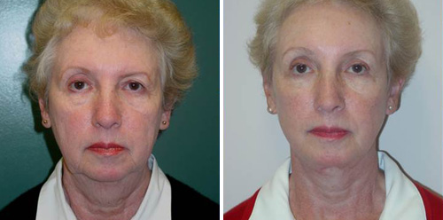 Facelift Before & After Photos