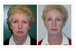 Facelift Before & After Photos