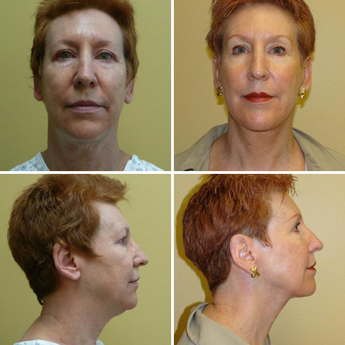 Facelift Before & After Photos