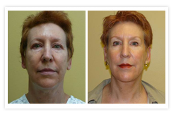 Facelift Before & After Photos