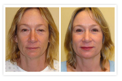 Facelift Before & After Photos