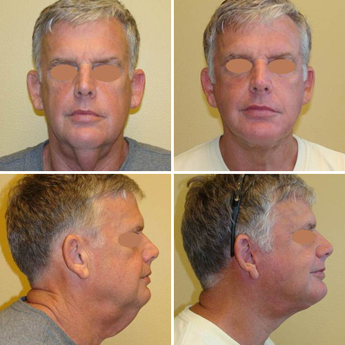 Facelift Before & After Photos