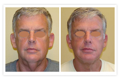 Facelift Before & After Photos