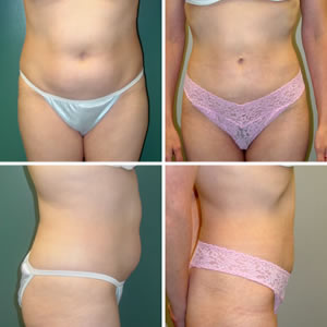 Liposuction Before & After Photos