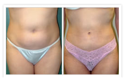 Liposuction Before & After Photos