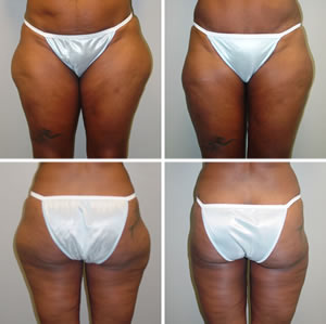 Liposuction Before & After Photos