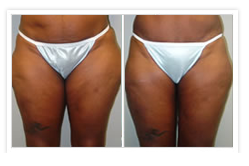 Liposuction Before & After Photos