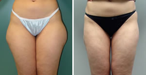 Liposuction Before & After Photos