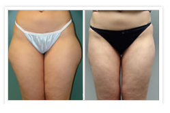 Liposuction Before & After Photos