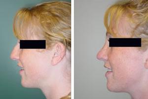 Rhinoplasty Before & After Photos