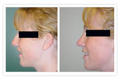 Rhinoplasty Before & After Photos