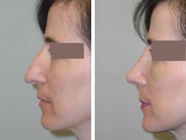 Rhinoplasty Before & After Photos