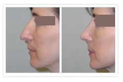 Rhinoplasty Before & After Photos