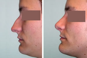 Rhinoplasty Before & After Photos