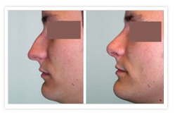 Rhinoplasty Before & After Photos