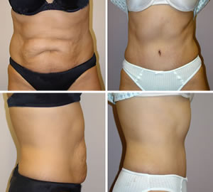 Tummy Tuck Before & After Photos