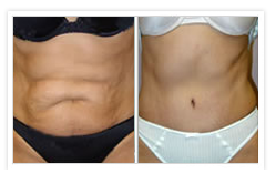 Tummy Tuck Before & After Photos