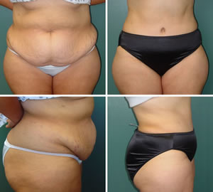 Tummy Tuck Before & After Photos