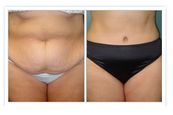 Tummy Tuck Before & After Photos